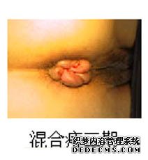 專家教你如何預(yù)防混合痔