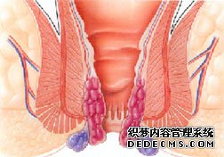 混合痔的治療方法有哪些