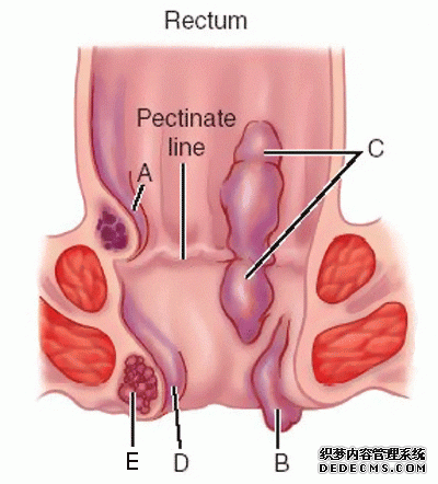 內(nèi)痔瘡癥狀與其他疾病有哪些不同？