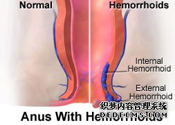 外痔早期癥狀有哪些？
