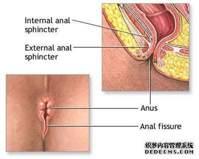 肛裂是什么引起的