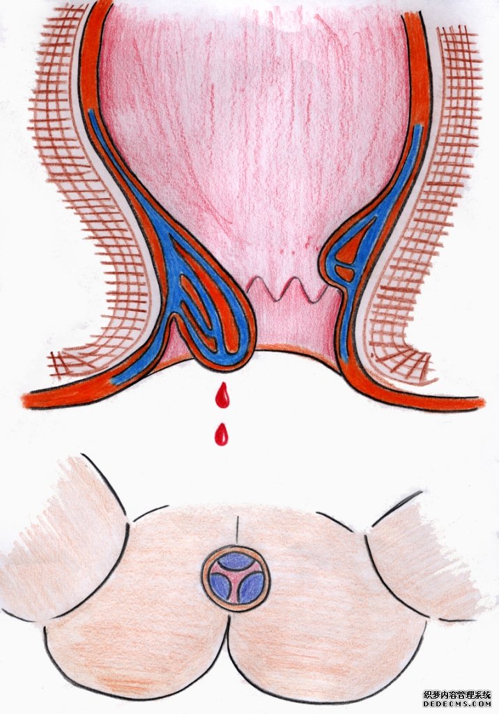肛腸疾病怎么導致便血的